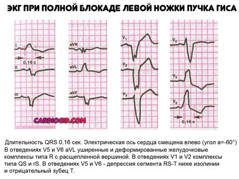 Полная блокада левой ножки пучка Гиса: