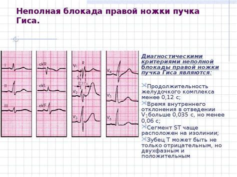 Полная блокада правой ножки гипса