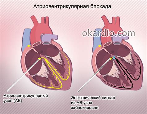 Полная блокада сердца: что это такое?