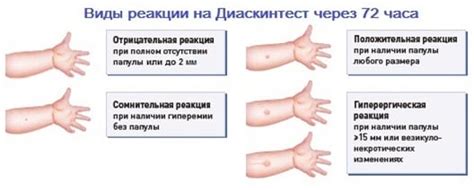 Положительный результат Диаскинтеста и диагностика туберкулеза