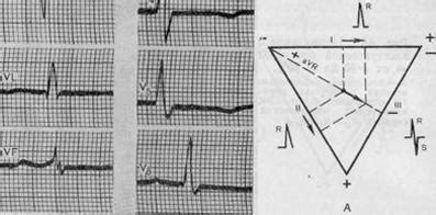 Полугоризонтальное положение электрической оси сердца и его причины