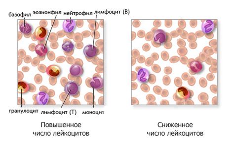 Пониженные гранулоциты у взрослых: причины и симптомы