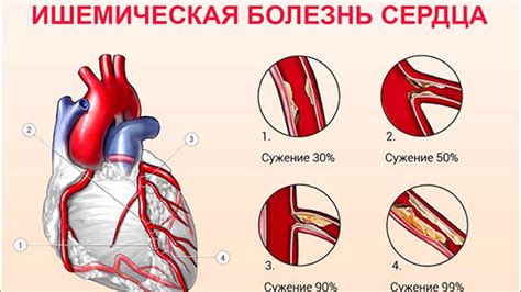 Понятие бреда сердца