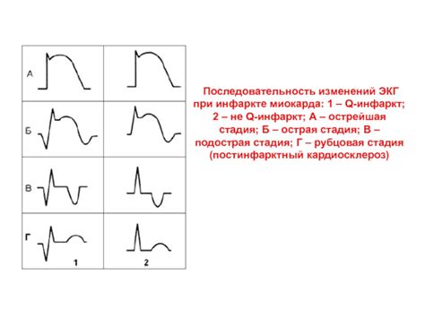 Понятие диффузных изменений миокарда ЛЖ