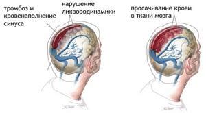 Понятие и основные причины неслияния синусов головного мозга