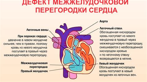 Понятие и причины нарушения межжелудочковой проводимости