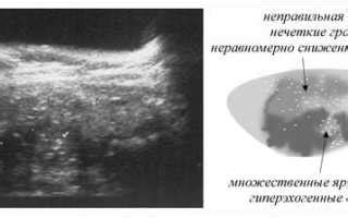 Понятие и характеристика штриховидных гиперэхогенных включений