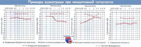 Понятие костной проводимости звука