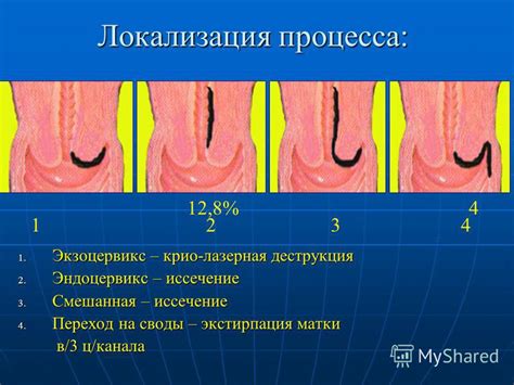 Понятие локализации экзоцервикс и эндоцервикс