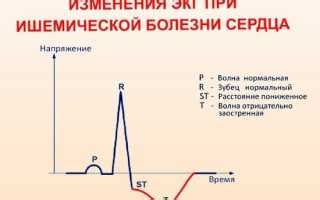 Понятие неспецифических нарушений реполяризации