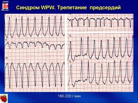 Понятие пароксизмальных нарушений ритма