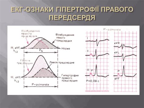 Понятие расширенного правого предсердия