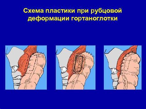 Понятие рубцовой деформации ЛДПК