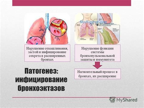 Понятие тубулярных бронхоэктазов и их особенности