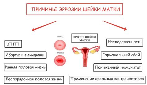 Понятие хронического эндоцервицита