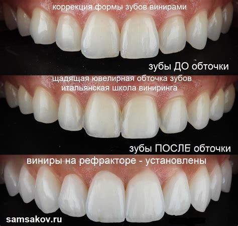 Популярность виниров на рефракторе