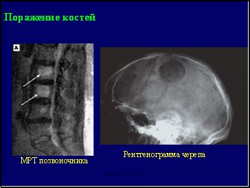 Поражение костей: что, если костно-деструктивные изменения не обнаружены?