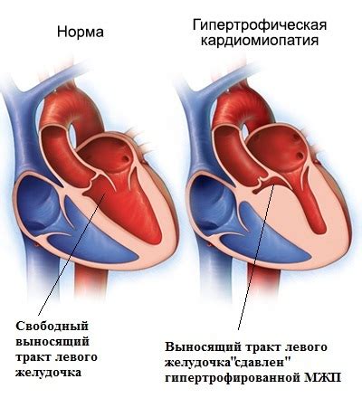 Последствия атрофии левого желудочка сердца