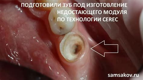 Последствия гниения корня зуба