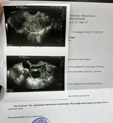 Последствия и возможные проблемы при тонком эндометрии