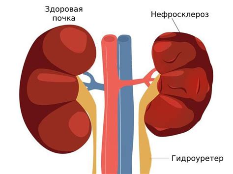 Последствия и осложнения нефроптоза 1 степени слева