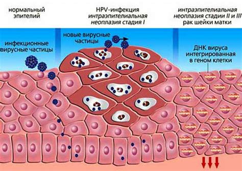 Последствия и осложнения при заражении ВПЧ 51