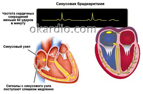 Последствия и осложнения синусовой брадиаритмии