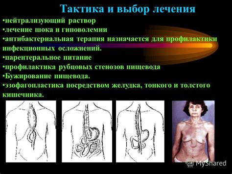 Последствия метаплазии пищевода без лечения