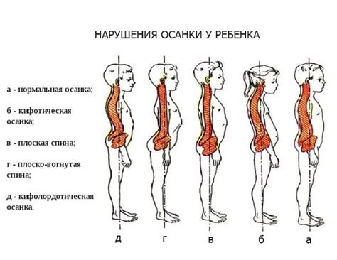 Последствия нарушения осанки у ребенка