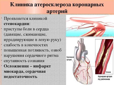 Последствия нижнего инфаркта миокарда