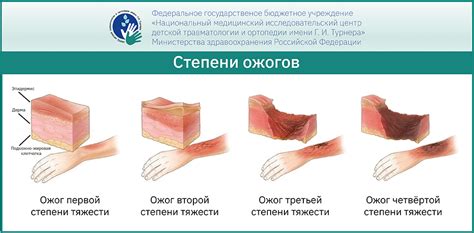 Последствия ожогов у девушек: физические и психологические аспекты