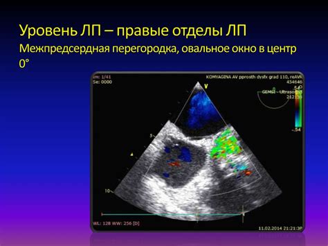 Последствия открытого овального окна у новорожденных