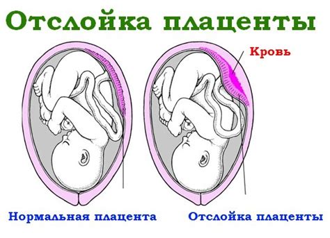 Последствия отслойки хориона для ребенка