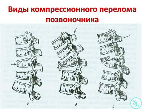 Последствия отсутствия стержня для позвоночника