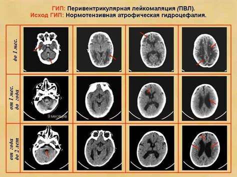 Последствия перивентрикулярной лейкомаляции