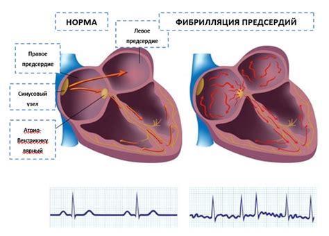 Последствия персистирующей формы фибрилляции предсердий