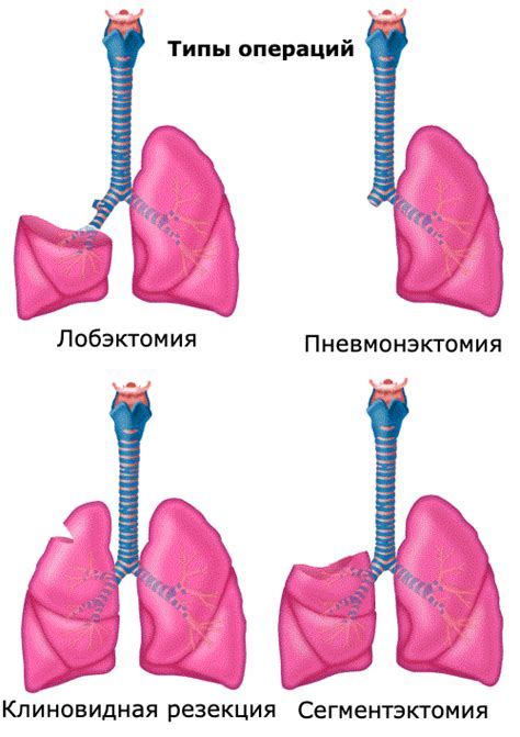 Последствия плавления легких