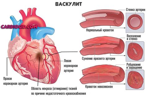 Последствия повышенной фракции выброса сердца