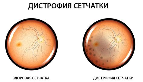 Последствия припайки сетчатки глаза и возможные осложнения