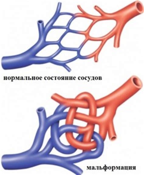 Последствия расширенных сосудов легких