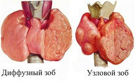 Последствия увеличения щитовидной железы: основные факторы