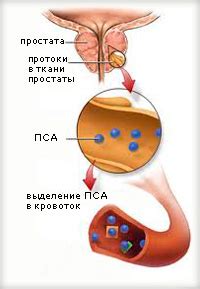 Последствия увеличенного пса при аденоме простаты