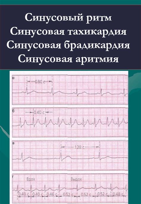 Последствия ускоренного нижнепредсердного ритма