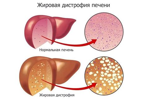 После алкогольного опьянения: ломки печени - причины и последствия