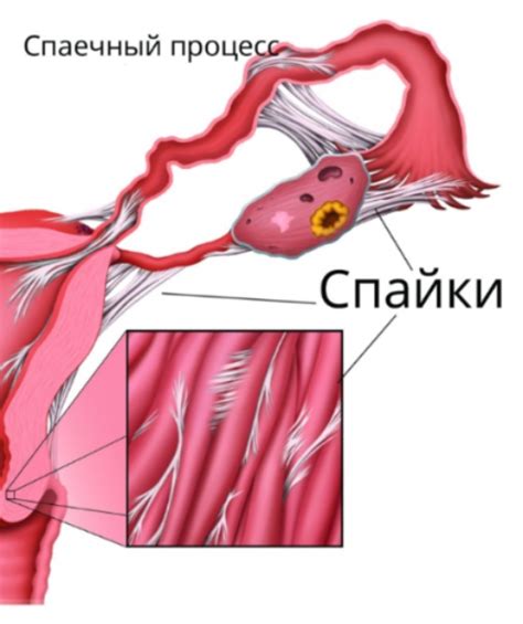 Постоянные спайки и их влияние