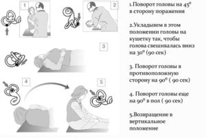 Постуральное головокружение