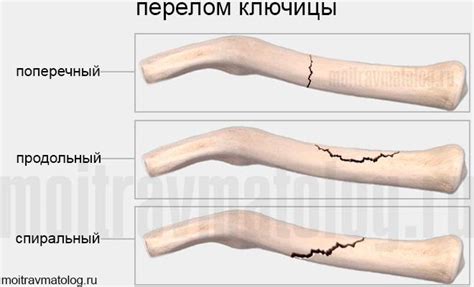 Почему бедренная кость не срастается после перелома и как исправить ситуацию