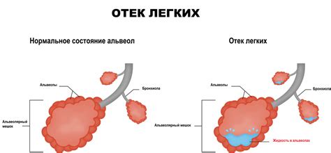 Почему возникает отек легких?