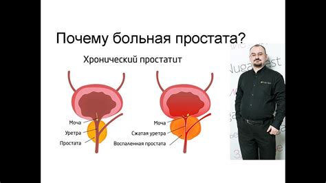 Почему возникает уплотнение простаты?