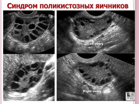 Почему возникают мелкие фолликулы на периферии: причины и лечение